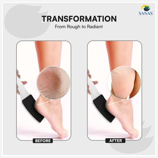 Sanas Dead Skin Remover Foot Scrubber - 1Pc